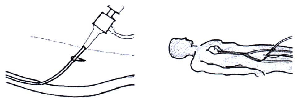 Insertion of introducer Sheath into the femoral artery