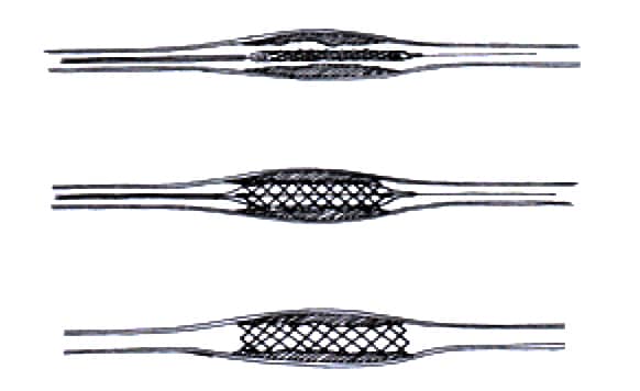 Stent placement in a coronary artery
